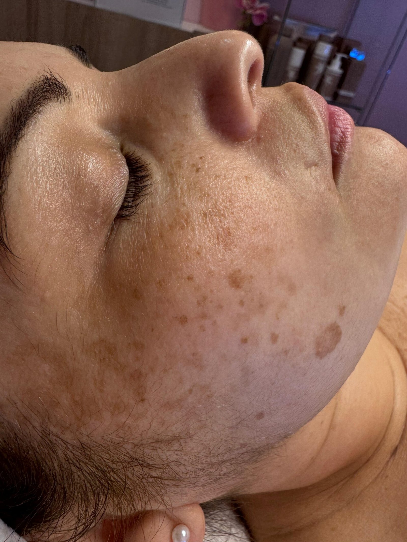 Peeling facial en Benalmádena Peeling facial en Benalmádena