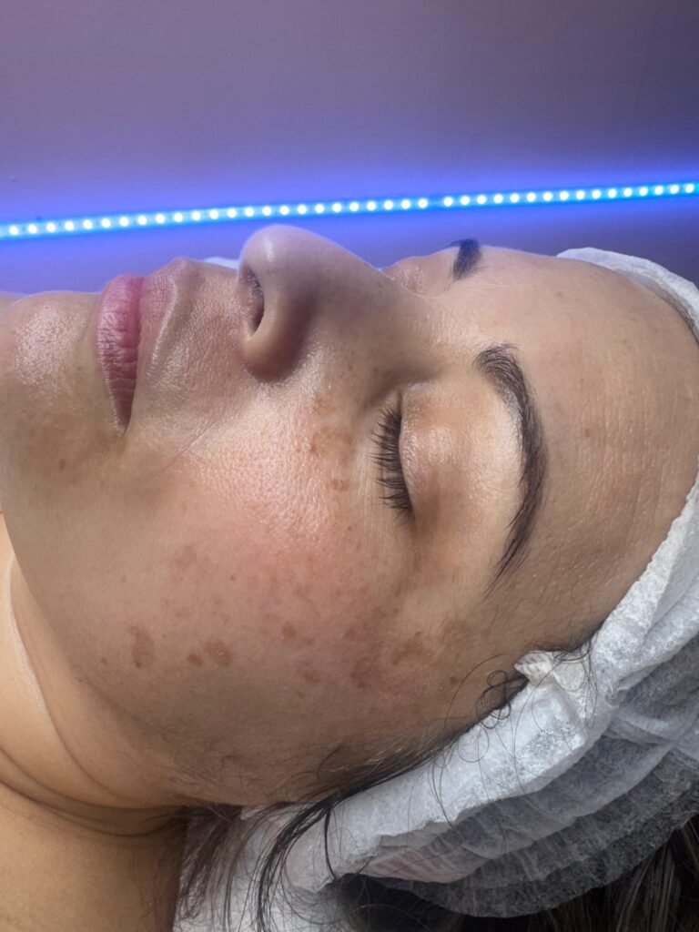 Resultado de peeling facial químico Resultado de peeling facial químico en piel Benalmádena
