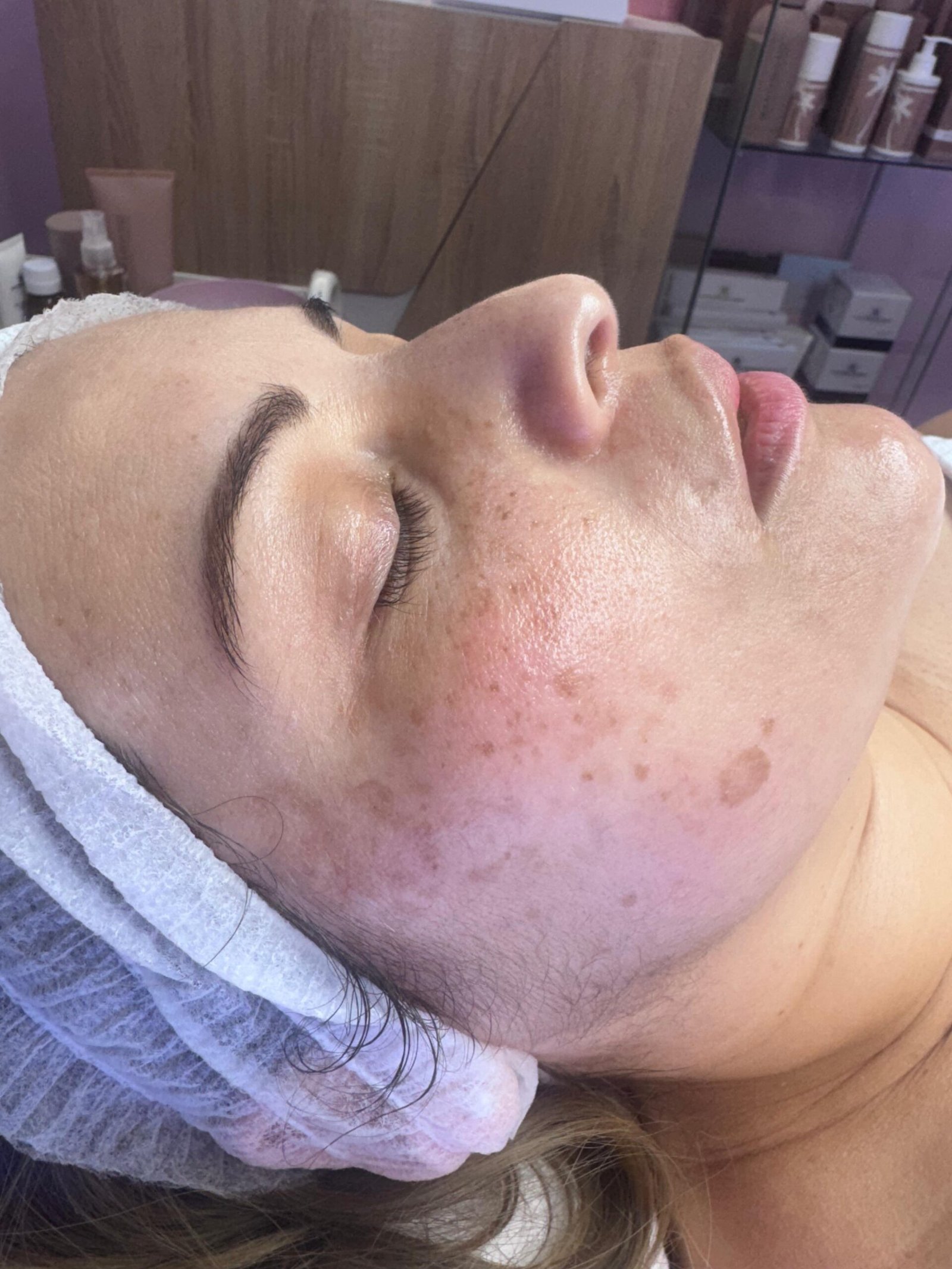 Resultado de peeling facial químico en piel con manchas, Benalmádena Resultado de peeling facial químico en piel con manchas, Benalmádena